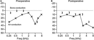 Biomechanics of Third Window Syndrome